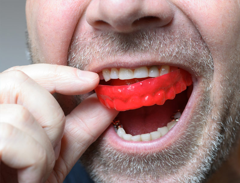 mouth-guards-in-edina