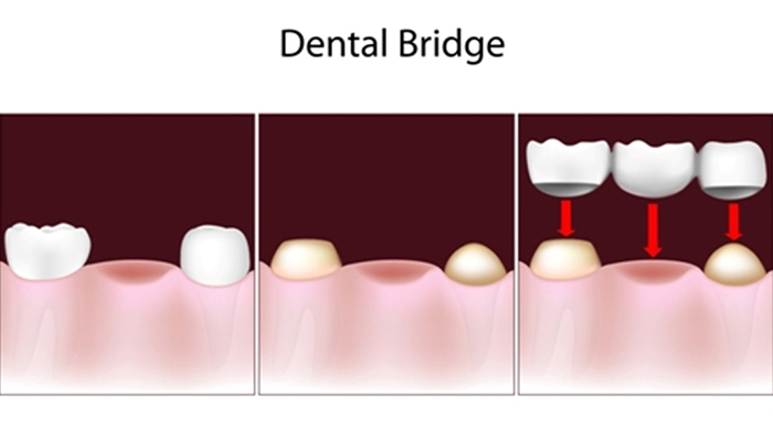 porcelain-fixed-bridges-in-edina