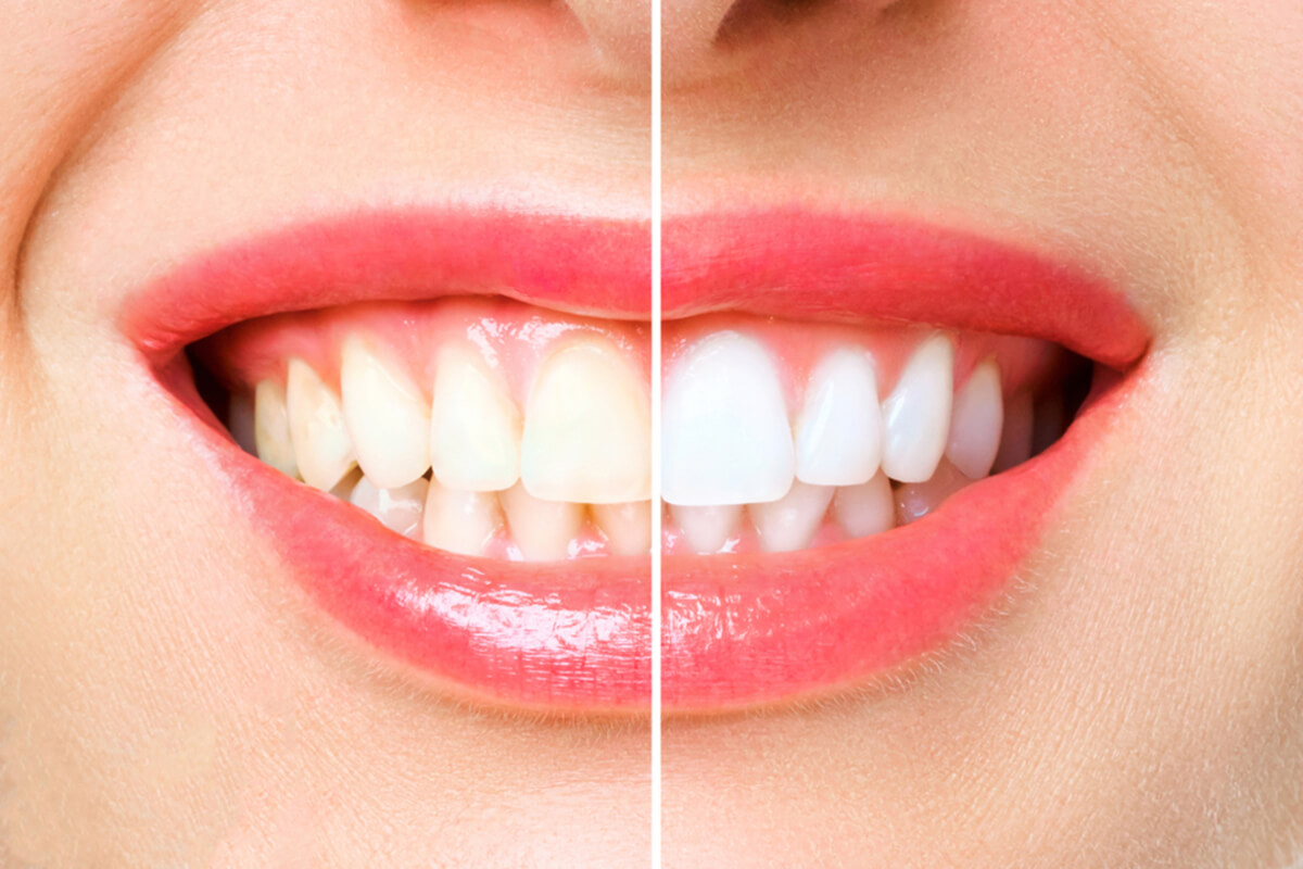 how long does it take to get teeth whitened professionally