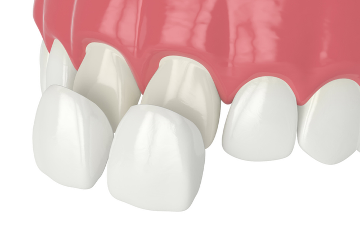 resin veneers vs. porcelain which is the right choice for your smile