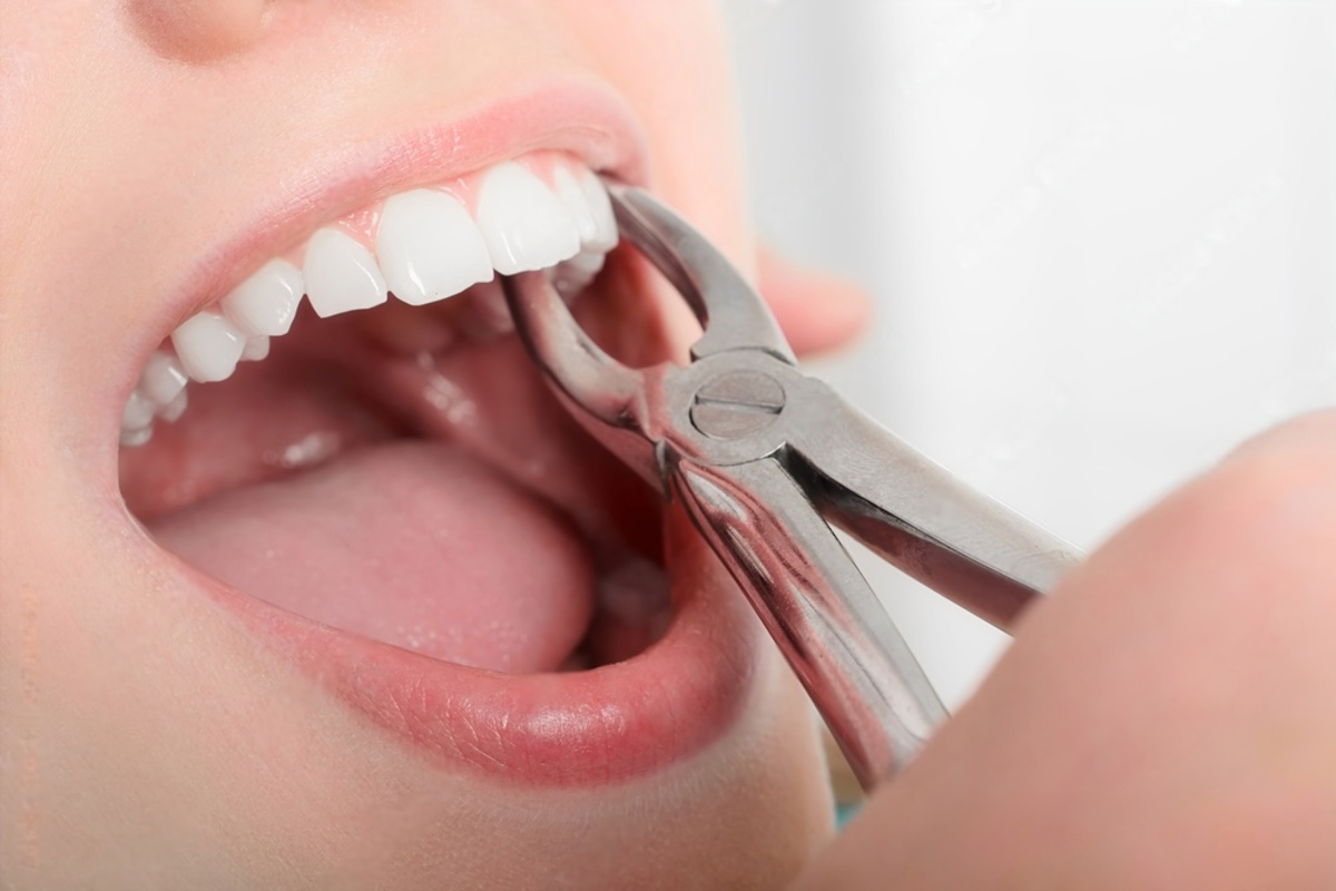 a guide to eating after tooth extraction