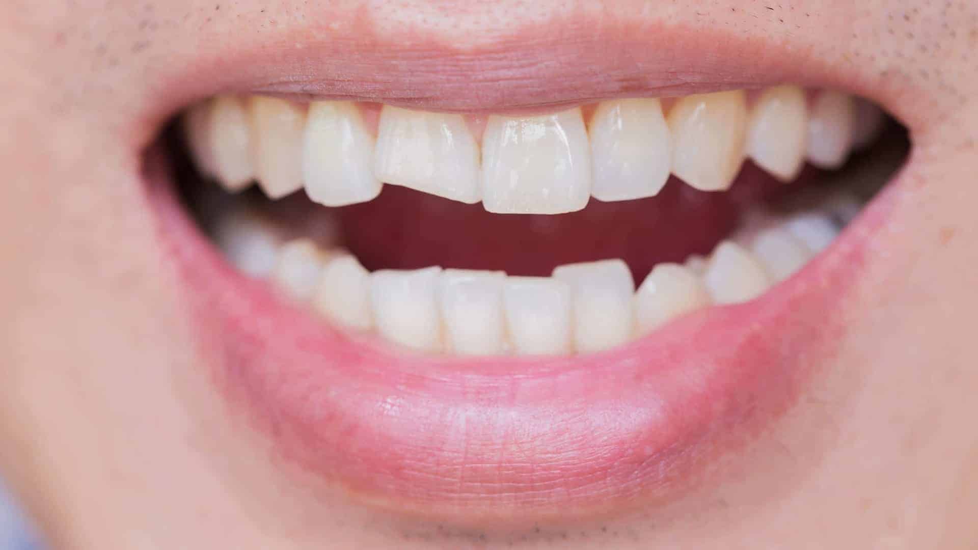 chipped tooth